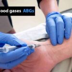 Arterijski ili kapilarni gasovi: između smjernica i “refleksnog bockanja”